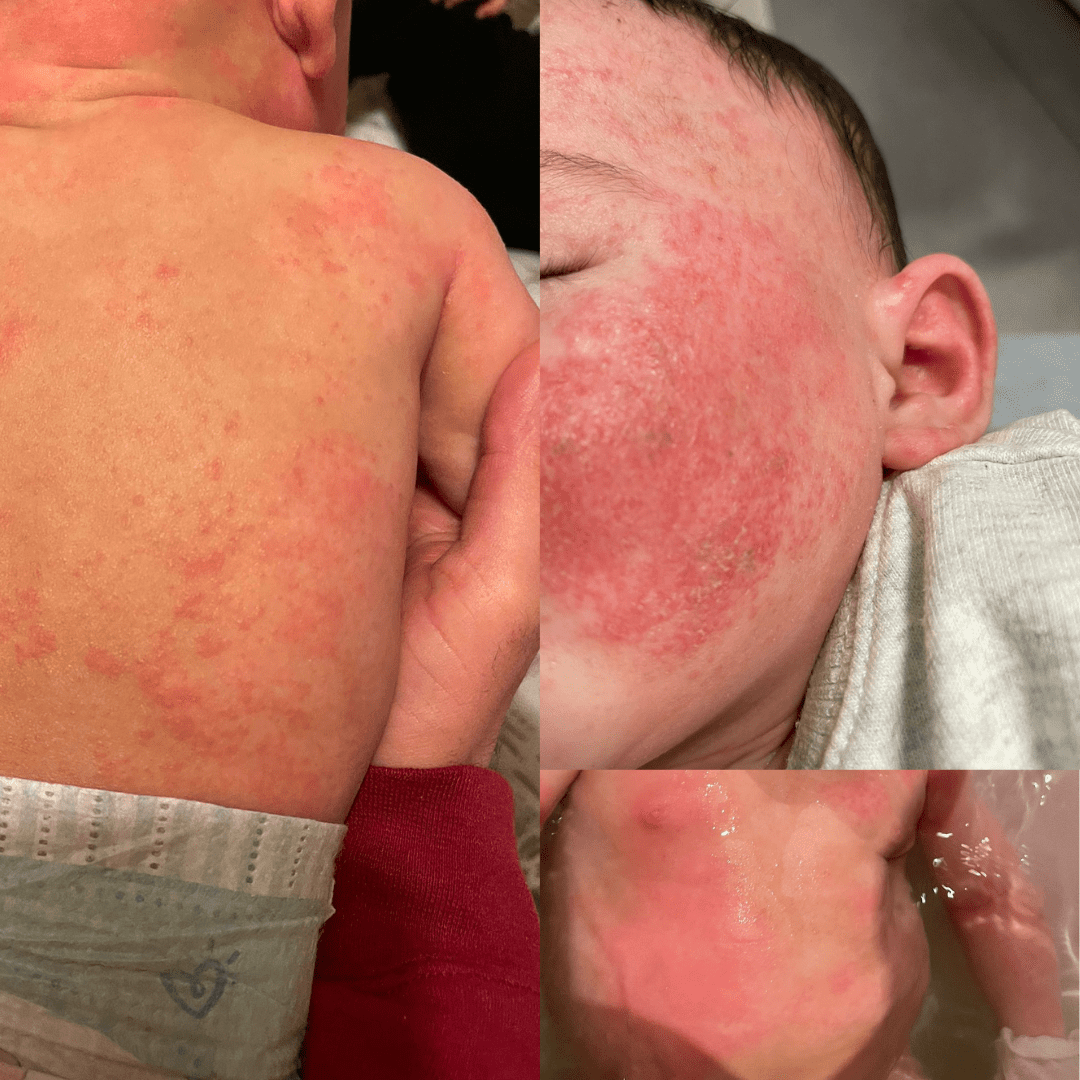 Chronic eczema